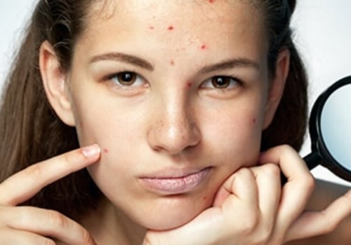 Acne Facials: A Comprehensive Guide